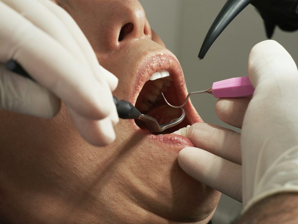 Dentiste examinant les gencives d'un patient à la sonde parodontale : dépistage de la parodontite à Athis-Mons