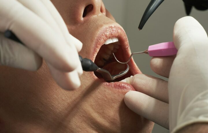 Dentiste examinant les gencives d'un patient à la sonde parodontale : dépistage de la parodontite à Athis-Mons