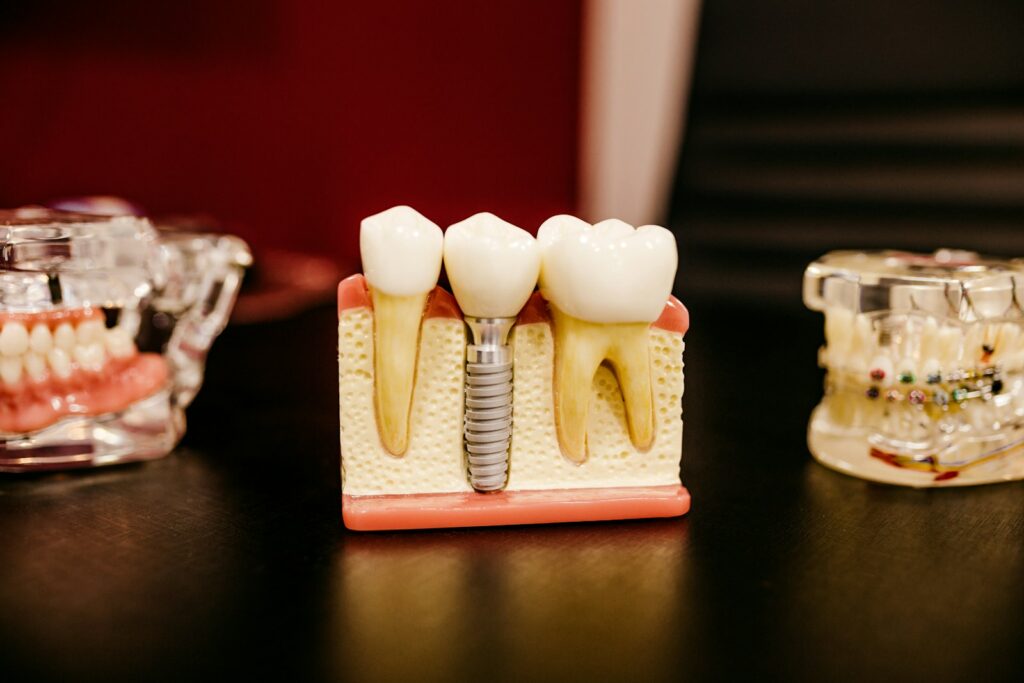 Modèle pédagogique d'implant dentaire avec couronne
