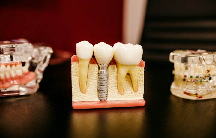 Modèle pédagogique d'implant dentaire avec couronne
